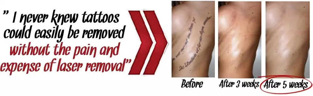 Laserless Tattoo Removal Guide